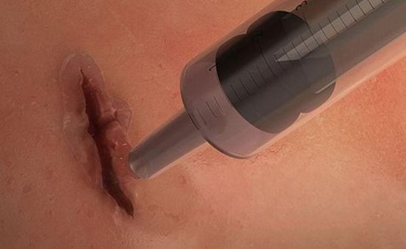 Bir dəqiqə ərzində yaraları sağaldan elastik yapışqan ixtira edilib, Elm və Təhsil Nazirliyi, Elm ve Tehsil Nazirliyi, Azərbaycan Respublikası Elm və Təhsil Nazirliyi, Azerbaycan Respublikasi Elm ve Tehsil Nazirliyi, Elm və Ali Təhsil üzrə Dövlət Agentliyi, Elm və Ali Təhsil, AMEA, Azərbaycan Milli Elmlər Akademiyası, Elmler Akademiyasi, İnformasiya Texnologiyaları İnstitutu, İnformasiya Texnologiyaları, AMEA ITI, AMEA İTİ, İTİ, ITI, ikt.az, ict.az, ict, ikt, www.ict.az, www.ikt.az, Rasim Aliguliyev, Rasim Əliquliyev, RM Əliquliyev, Əliquliyev Rasim, Academician Rasim Aliguliyev