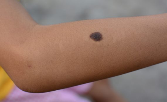 Süni xal xərçəng xəstəliyi barədə xəbərdarlıq edəcək, Elm və Təhsil Nazirliyi, Elm ve Tehsil Nazirliyi, Azərbaycan Respublikası Elm və Təhsil Nazirliyi, Azerbaycan Respublikasi Elm ve Tehsil Nazirliyi, Elm və Ali Təhsil üzrə Dövlət Agentliyi, Elm və Ali Təhsil, AMEA, Azərbaycan Milli Elmlər Akademiyası, Elmler Akademiyasi, İnformasiya Texnologiyaları İnstitutu, İnformasiya Texnologiyaları, AMEA ITI, AMEA İTİ, İTİ, ITI, ikt.az, ict.az, ict, ikt, www.ict.az, www.ikt.az, Rasim Aliguliyev, Rasim Əliquliyev, RM Əliquliyev, Əliquliyev Rasim, Academician Rasim Aliguliyev