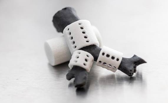 3D-printed tracheal tires saved the life of a child