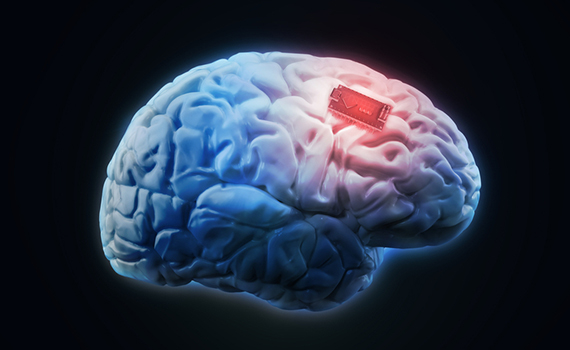 Brain implant can prevent epileptic seizures