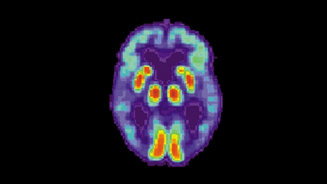 Süni intellekt Alzheimer xəstəliyini 6 il öncədən müəyyənləşdirir