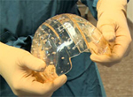 3D-Printed Skull Replacement Transplant