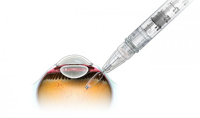 Yeni göz implantatı yaşlı insanlarda korluğun qarşısını almağa imkan verəcək, Elm və Təhsil Nazirliyi, Elm ve Tehsil Nazirliyi, Azərbaycan Respublikası Elm və Təhsil Nazirliyi, Azerbaycan Respublikasi Elm ve Tehsil Nazirliyi, Elm və Ali Təhsil üzrə Dövlət Agentliyi, Elm və Ali Təhsil, AMEA, Azərbaycan Milli Elmlər Akademiyası, Elmler Akademiyasi, İnformasiya Texnologiyaları İnstitutu, İnformasiya Texnologiyaları, AMEA ITI, AMEA İTİ, İTİ, ITI, ikt.az, ict.az, ict, ikt, www.ict.az, www.ikt.az, Rasim Aliguliyev, Rasim Əliquliyev, RM Əliquliyev, Əliquliyev Rasim, Academician Rasim Aliguliyev