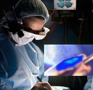 Sprayable Reagent Makes Cancer Tissues Glow During Surgery