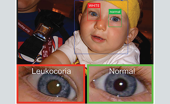 The new application will determine the early stages of eye disease from a photograph of the face