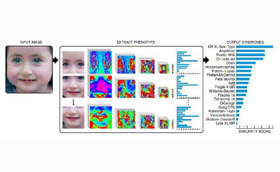 The neural network was taught to recognize 216 rare hereditary diseases from a photo