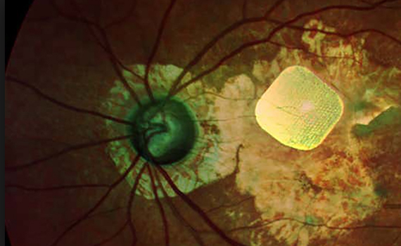 Gözdən əlil insanlara oxumaq imkanını geri qaytaran bionik göz təqdim olunub, Elm və Təhsil Nazirliyi, Elm ve Tehsil Nazirliyi, Azərbaycan Respublikası Elm və Təhsil Nazirliyi, Azerbaycan Respublikasi Elm ve Tehsil Nazirliyi, Elm və Ali Təhsil üzrə Dövlət Agentliyi, Elm və Ali Təhsil, AMEA, Azərbaycan Milli Elmlər Akademiyası, Elmler Akademiyasi, İnformasiya Texnologiyaları İnstitutu, İnformasiya Texnologiyaları, AMEA ITI, AMEA İTİ, İTİ, ITI, ikt.az, ict.az, ict, ikt, www.ict.az, www.ikt.az, Rasim Aliguliyev, Rasim Əliquliyev, RM Əliquliyev, Əliquliyev Rasim, Academician Rasim Aliguliyev