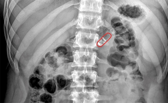 Bağırsağın daxilindən ağrısız inyeksiya edən “ağıllı” kapsul təqdim olunub, Elm və Təhsil Nazirliyi, Elm ve Tehsil Nazirliyi, Azərbaycan Respublikası Elm və Təhsil Nazirliyi, Azerbaycan Respublikasi Elm ve Tehsil Nazirliyi, Elm və Ali Təhsil üzrə Dövlət Agentliyi, Elm və Ali Təhsil, AMEA, Azərbaycan Milli Elmlər Akademiyası, Elmler Akademiyasi, İnformasiya Texnologiyaları İnstitutu, İnformasiya Texnologiyaları, AMEA ITI, AMEA İTİ, İTİ, ITI, ikt.az, ict.az, ict, ikt, www.ict.az, www.ikt.az, Rasim Aliguliyev, Rasim Əliquliyev, RM Əliquliyev, Əliquliyev Rasim, Academician Rasim Aliguliyev