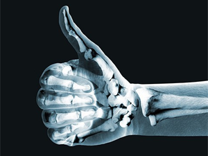Synthetic 3D-printed material helps bones regrow